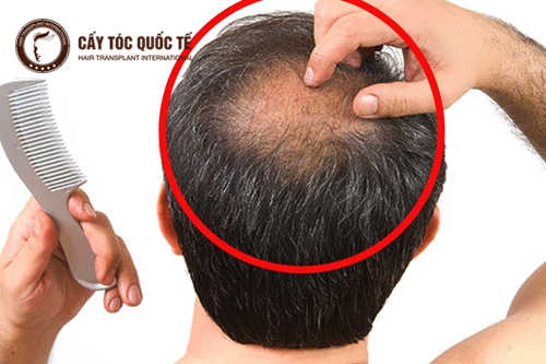 4 Cách chữa rụng tóc ở đỉnh đầu hiệu quả sau 7 ngày