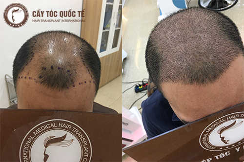 Nguyên nhân rụng tóc đỉnh đầu ở nam giới và cách điều trị