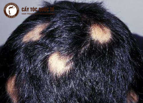 Rụng tóc từng mảng và cách chữa rụng tóc từng mảng