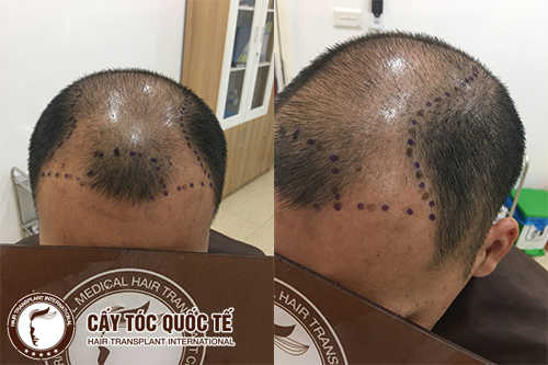 Điều trị dứt điểm rụng tóc bệnh nhân thoát được cảnh hói đầu khi mới 30   Petunia Charm Center