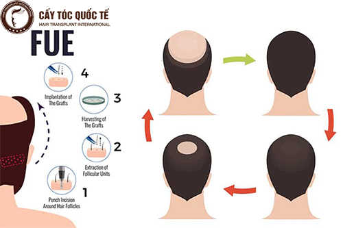 Công nghệ cấy tóc Fue, chọn lựa những nang tóc khỏe mạnh (thường là sau gáy) để đưa lên vùng bị hói
