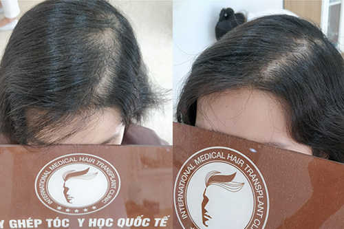 Tình trạng rụng tóc của chị Trang sau một thời gian dài bị rụng tóc