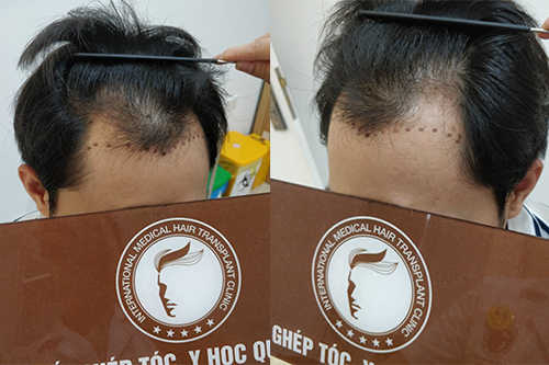 Rụng tóc hình chữ M hay rụng tóc 2 bên trán là hiện tượng khá phổ biến hiện nay.