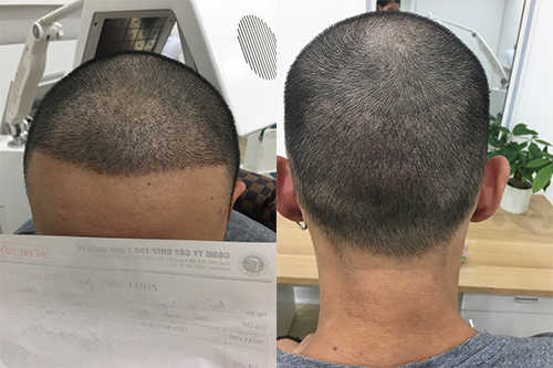 Hình ảnh sau 10 ngày của vùng hói trước trán và vùng cho tóc sau gáy