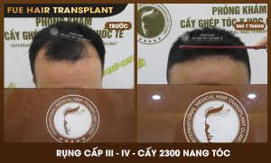 Anh Nguyễn Trường Giang, 28 tuổi, Hải Dương, đã trị hói chữ M cách đây 7 tháng Anh Nguyễn Trường Giang, 28 tuổi, Hải Dương, đã trị hói chữ M cách đây 7 tháng