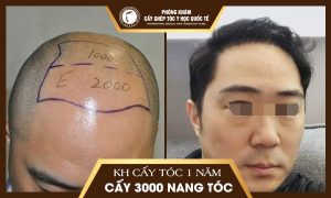 Anh Dương Anh Đức, 35 tuổi, Bắc Giang đã trị hói đầu cách đây 1 năm Anh Dương Anh Đức, 35 tuổi, Bắc Giang đã trị hói đầu cách đây 1 năm