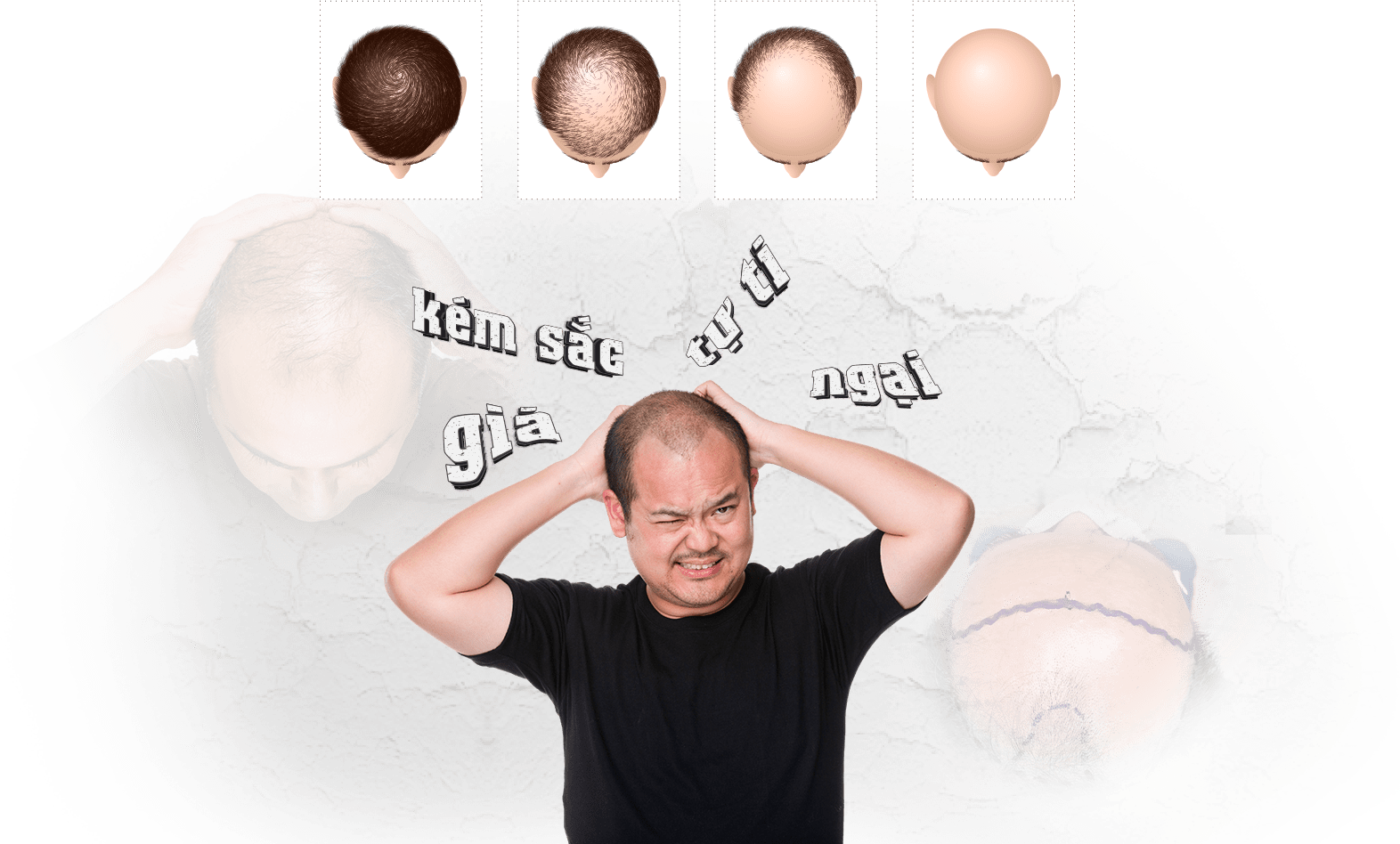 cấy ghép tóc y học