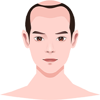 cấy ghép tóc y học