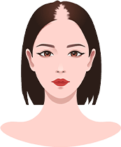 cấy ghép tóc y học