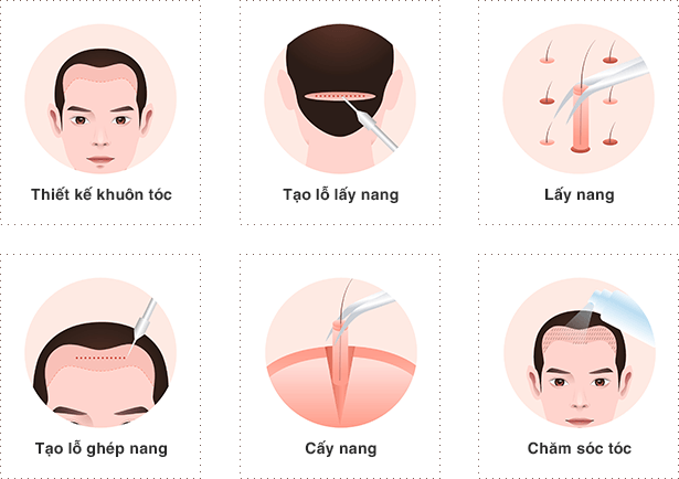 cấy ghép tóc y học