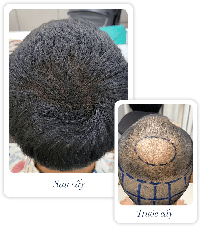 cấy ghép tóc y học