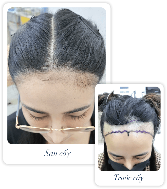 cấy ghép tóc y học