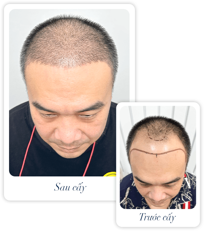 cấy ghép tóc y học