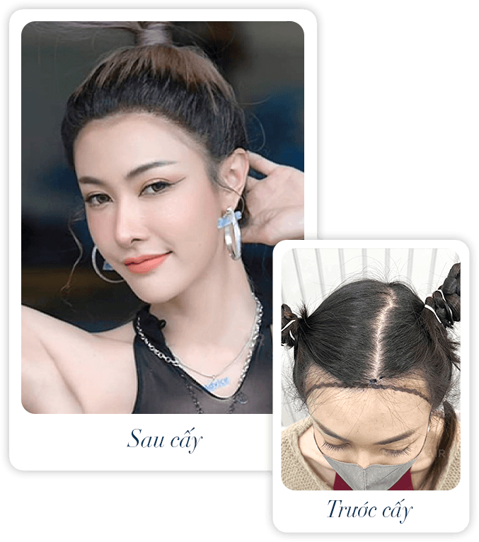 cấy ghép tóc y học