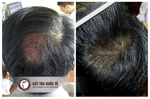 Cơ sở cấy tóc cho vùng sẹo trên da đầu uy tín tại Hà Nội
