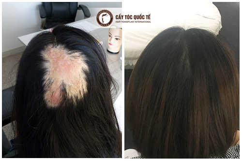 Bỏ túi các phương pháp che sẹo trên da đầu