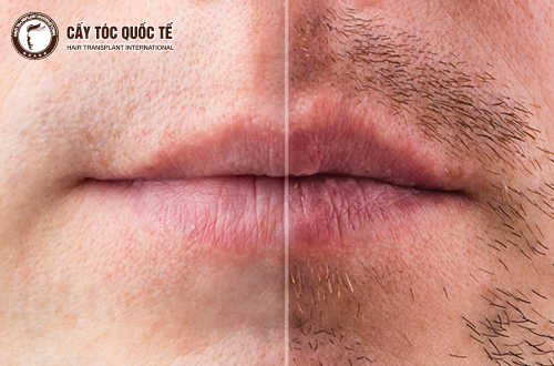 Tất tần tật thông tin từ A – Z về cấy râu cho nam giới