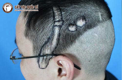 Đã có cách giải quyết sẹo da đầu xấu xí hiệu quả!