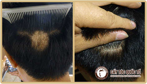 Cấy tóc cho vùng sẹo trên da đầu tại Phòng khám Cấy tóc quốc tế