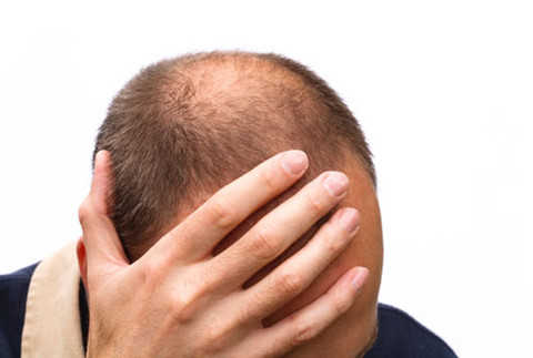 Tình trạng tóc thưa ở nam giới: Có phải hói đầu