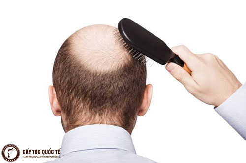 Những điều cần biết để khắc phục tóc thưa hói ở đỉnh đầu