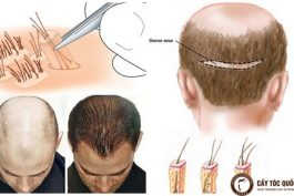 Có thể bạn chưa biết: Tác hại của các phương pháp cấy tóc hiện nay