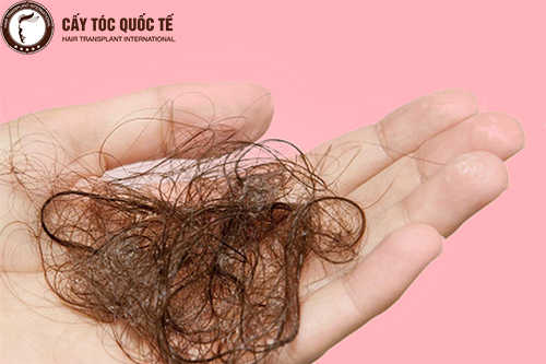 Nguyên nhân, cách khắc phục tình trạng rụng tóc mùa hè 
