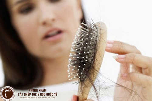 Tôi đã tìm ra cách trị rụng tóc nhiều ở nữ giới thật đơn giản