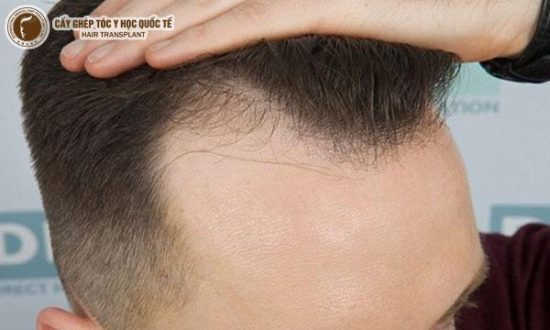Rụng tóc ở nam giới Nguyên nhân và cách khắc phục hiệu quả