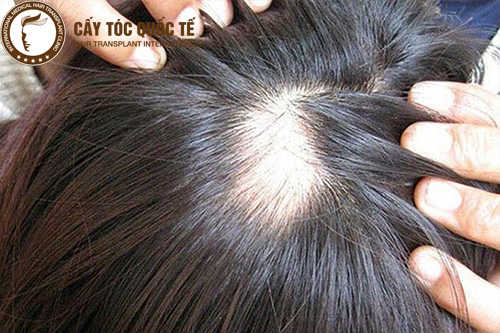 Tiết lộ cách trị hói tóc ở nữ nhanh và hiệu quả nhất