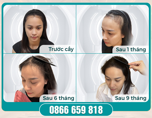 Cấy tóc là gì? Phân biệt cấy tóc sinh học & cấy tóc tự thân