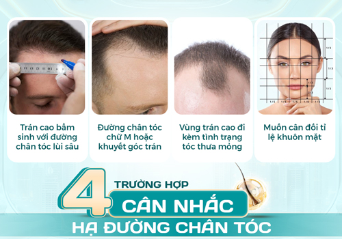 Hạ đường chân tóc là gì? Ưu điểm, hạn chế và những điều cần cân nhắc
